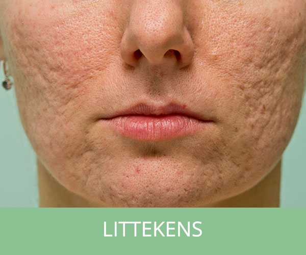 Afbeelding van vrouw met littekens op het gezicht van acne.